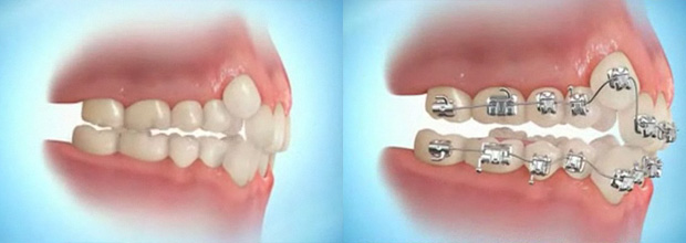 Ortodontik Bozukluk Nedenleri?