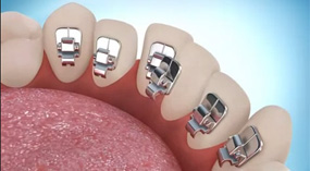 İçten Takılan Diş Telleri Lingual Ortodonti